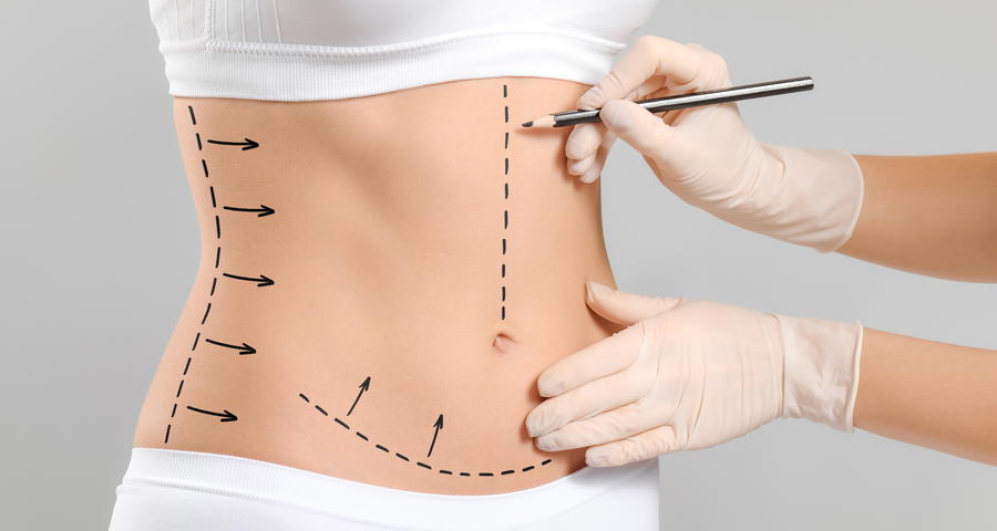 Safe and Effective Liposuction in Riyadh