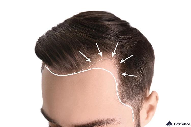 Complete Guide to Hair Restoration Options in Dubai: Surgical and Non-Surgical Solutions