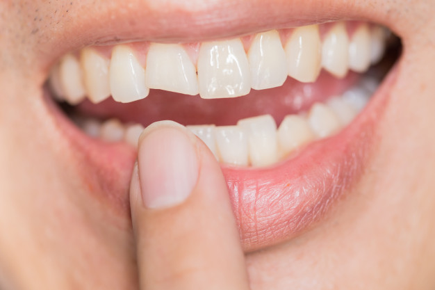 Safe Teeth Whitening: What You Need to Know About Sensitive Teeth