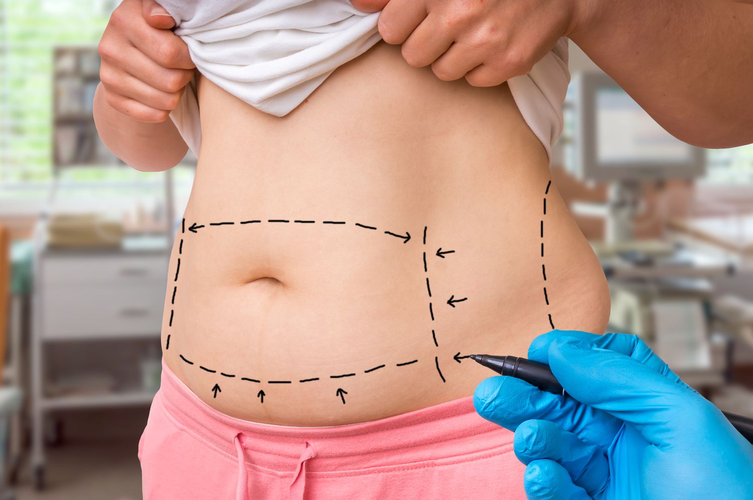 Find the Best Deals on Liposuction in Riyadh
