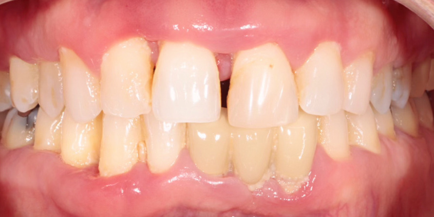 Full Mouth Dental Implants in Dubai Cost Breakdown and Insights
