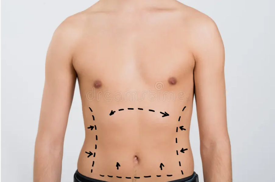 Top Patient Reviews for Liposuction Surgery in Riyadh