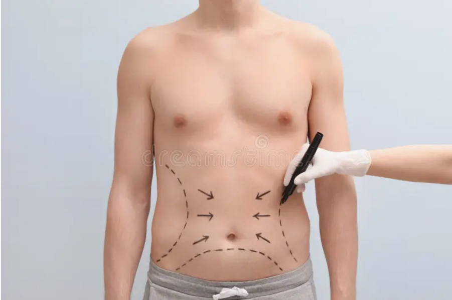 Patient Stories Successful Tummy Tuck Transformations in Riyadh