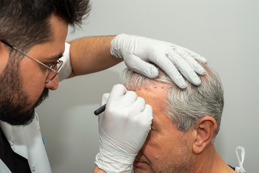 How Does Hair Transplant Work?