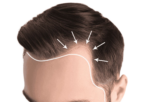 Hair Transplant Costs in Riyadh: A Closer Look at Pricing