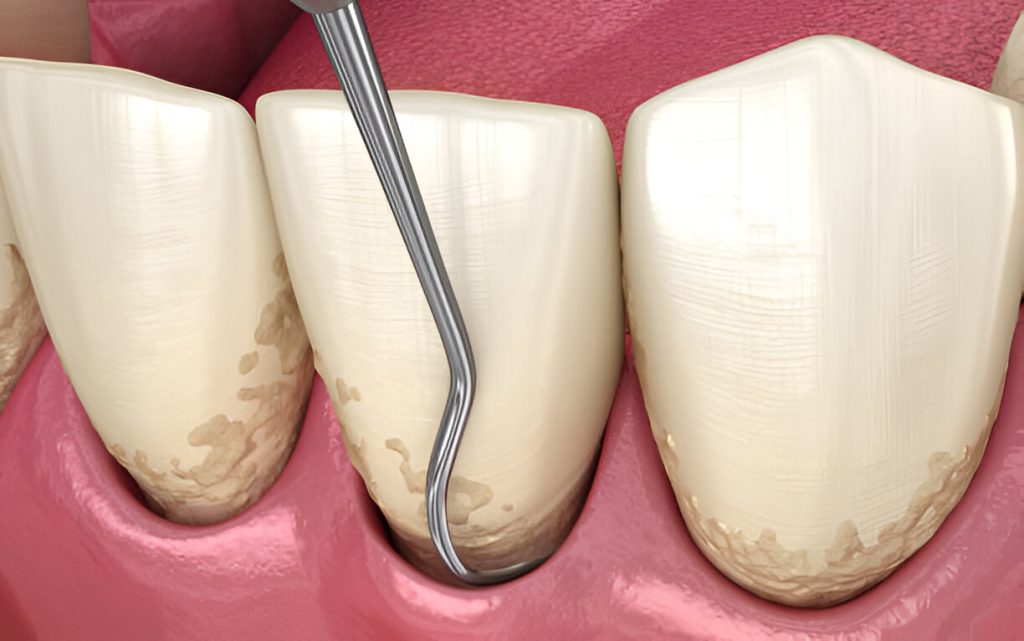 5 Powerful Benefits of Periodontal Surgery Newark for Health 