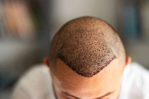 زراعة الشعر في الرياض: كل ما تحتاج معرفته قبل اتخاذ القرار