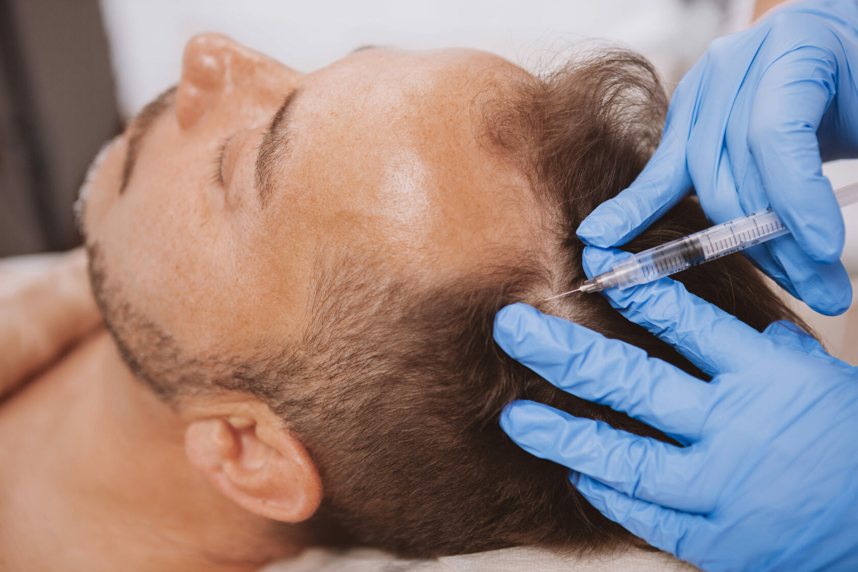 PRP Hair Treatment vs. Alternatives: Riyadh's Experts Weigh In