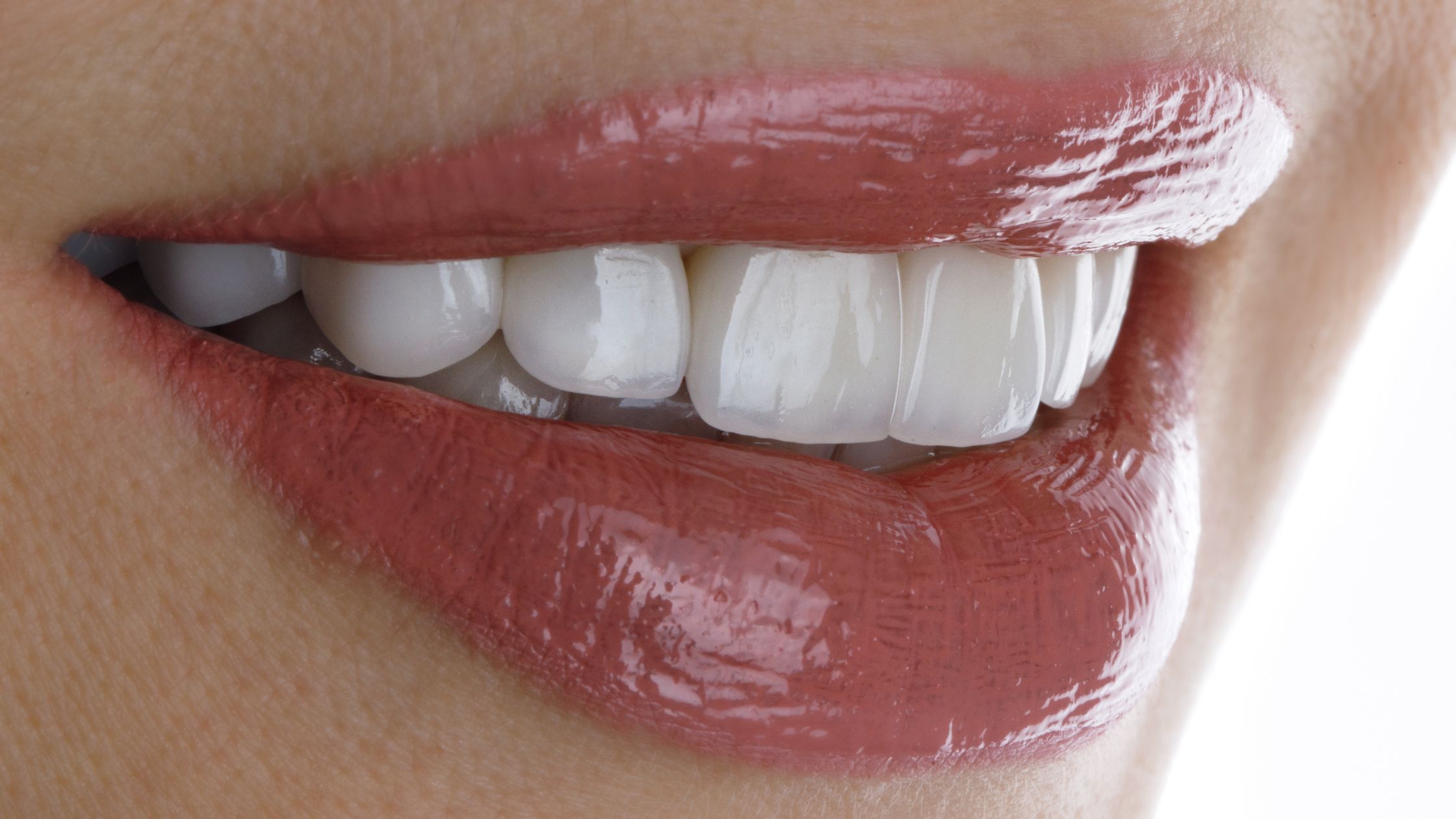 Porcelain Veneers in Colombia: The Ultimate Smile Makeover