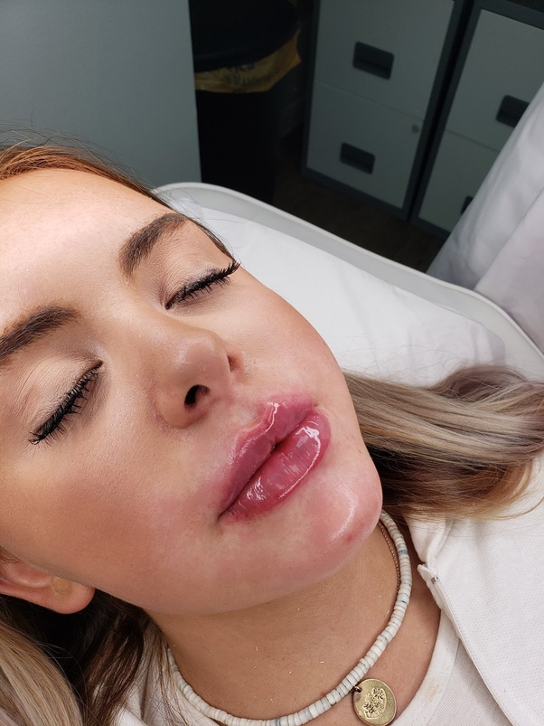 The Best Russian Lip Filler Specialists in Dubai &ndash; Transform Your Look