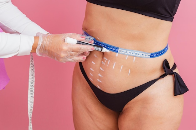 What are five things  to Know about stomach liposuction?