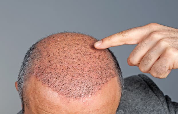 Are Hair Transplants in Dubai Worth the Cost?
