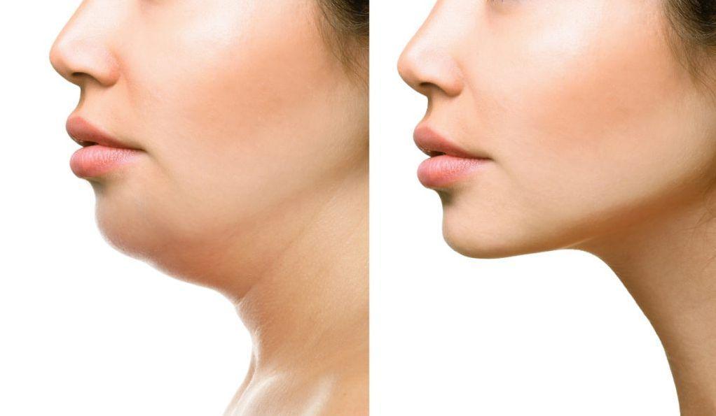 Radiofrequency treatments for double chin in Riyadh