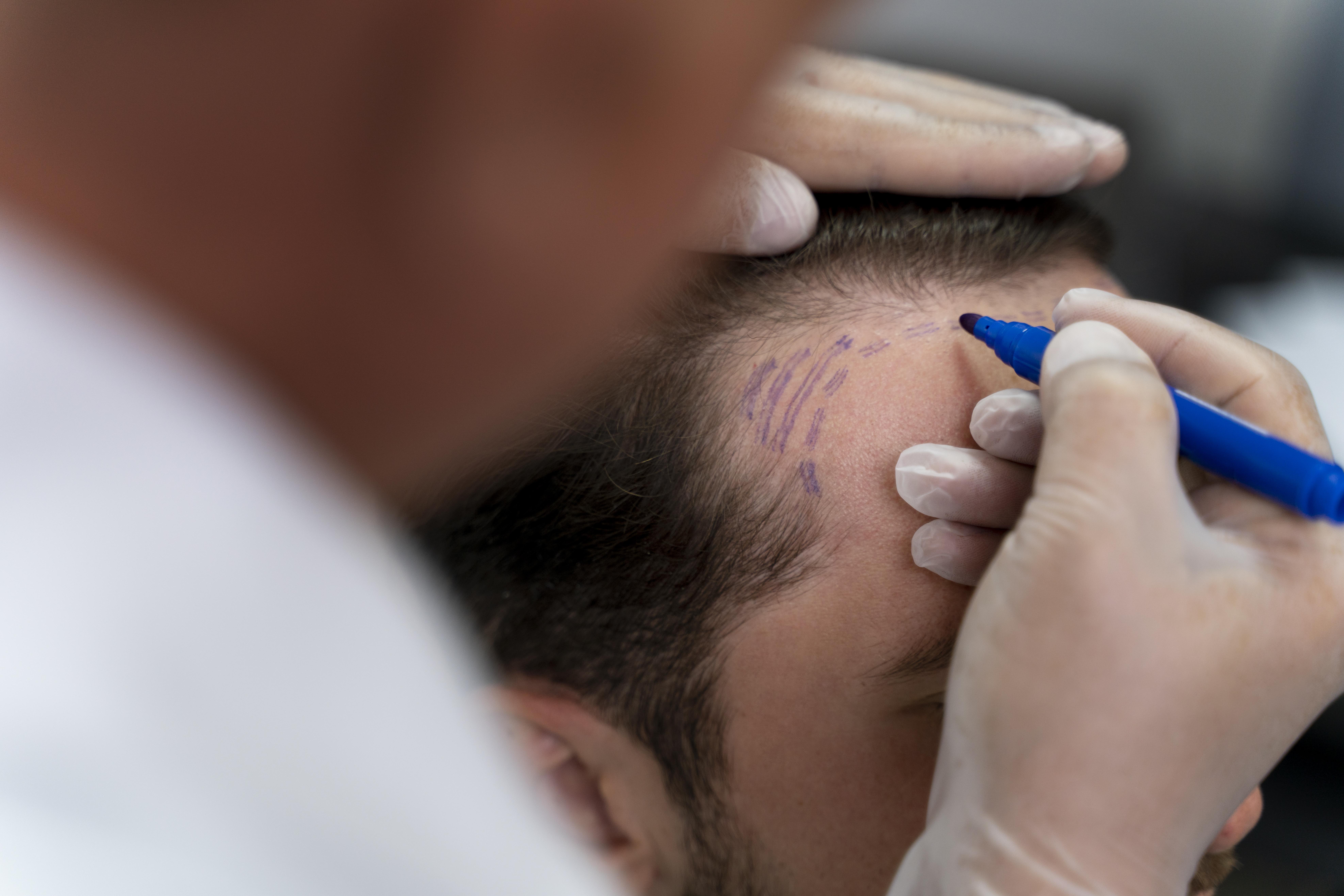 From Gurgaon to Lucknow: Affordable Hair Transplant Solutions for Every Budget