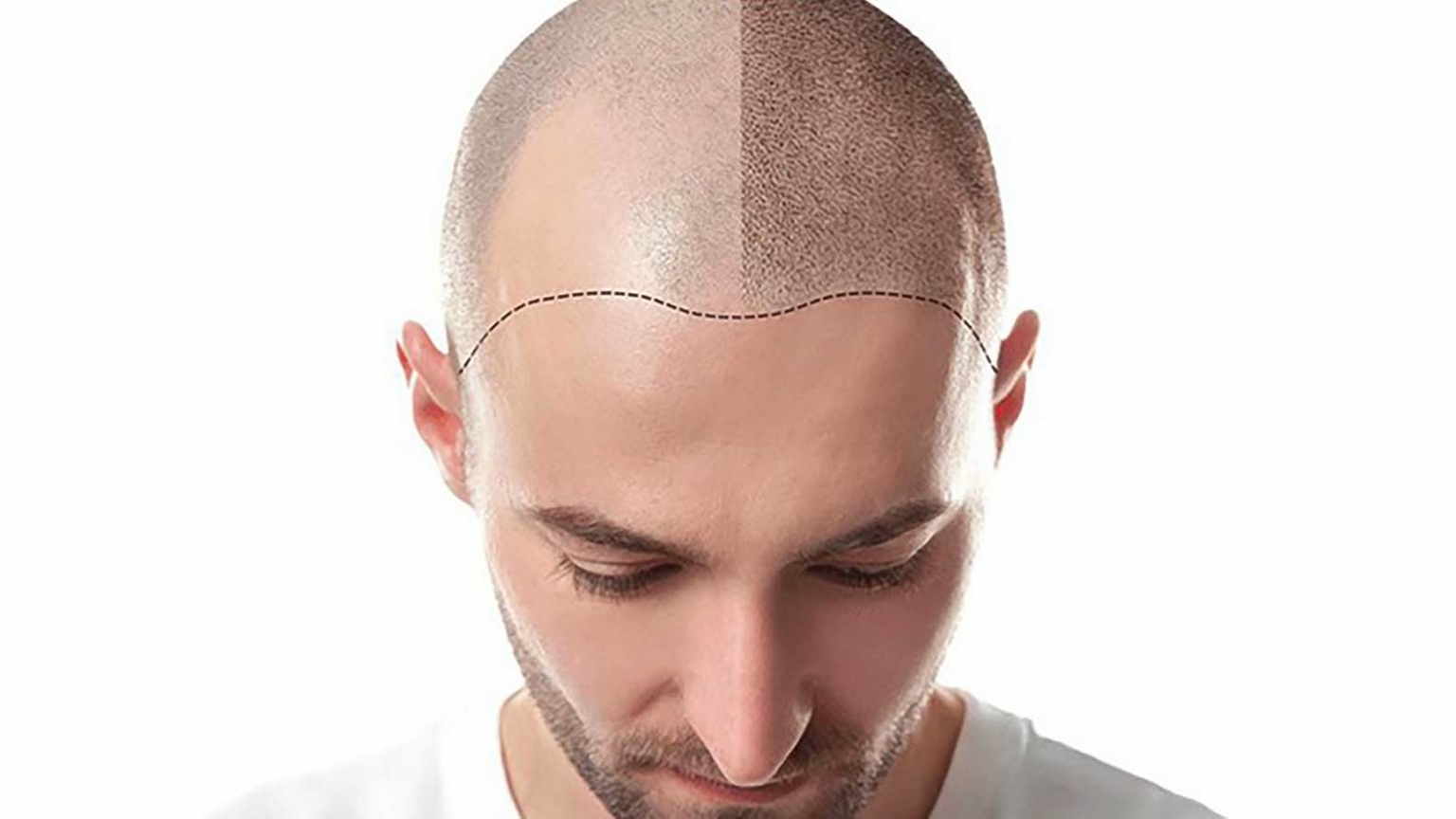 Hidden Costs of Hair Transplants in Riyadh: What You Should Know