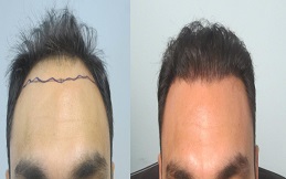 Affordable Hair Transplant in Dubai &ndash; Natural & Permanent Results