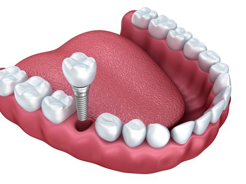 Dental Implants in Halifax: A Permanent Solution for Missing Teeth