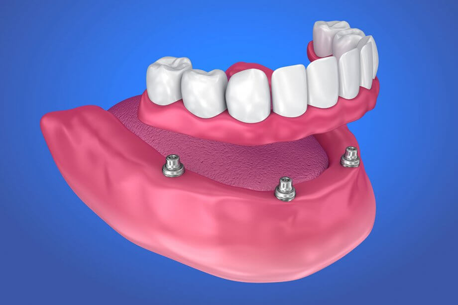 Top Newark Dentist Tips for Healthier Gums and Teeth 