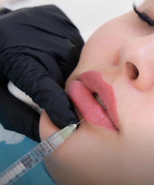Top Lip Filler Injections in Dubai &ndash; Natural Results