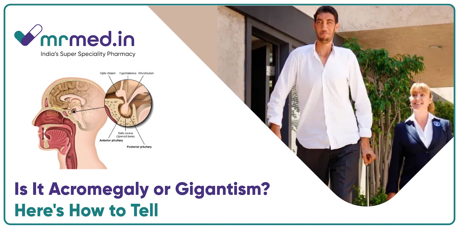 Acromegaly vs. Gigantism: What&rsquo;s the Difference?