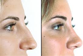 Fix, Refine, and Feel Great &ndash; Why Rhinoplasty Is Worth It