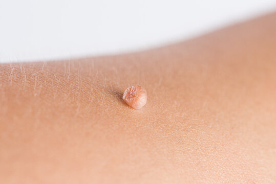 How Can I Tell If It&rsquo;s A Skin Tag Or Something Else?