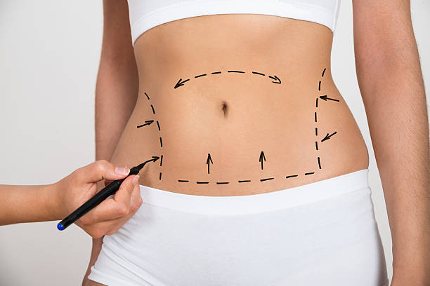 Riyadh's Cutting-Edge Liposuction Breakthroughs 2024