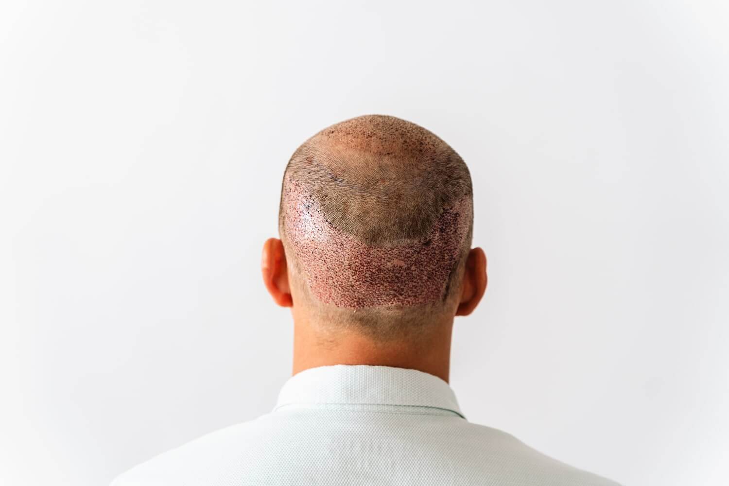 زراعة الشعر في الرياض: دليلك الشامل لاستعادة الشعر