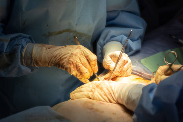 Discover the Best Tummy Tuck Options in Riyadh