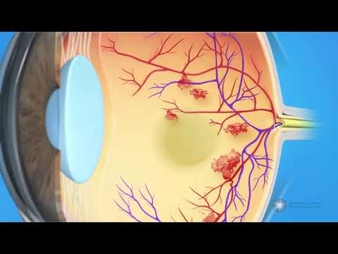 Sudden Blurred Vision: When to Seek Medical Help