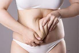 Is a Tummy Tuck Safe for Older Adults?