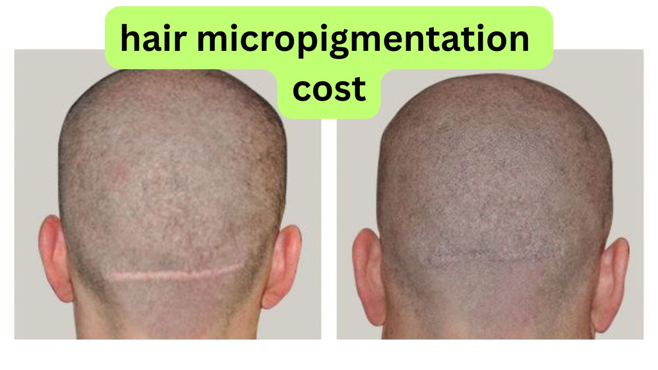 Affordable Hair Micropigmentation: Cost Explained 