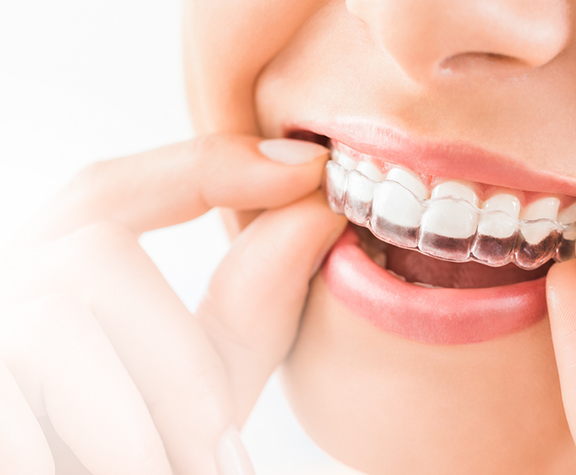 A Clearer Smile: What Invisalign Can Do in Cardiff