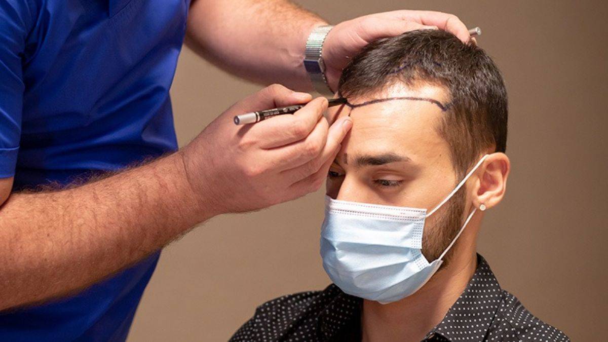 Long Hair Transplant in Islamabad: No Shaving Required