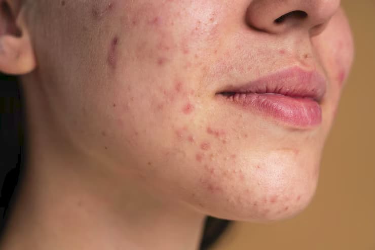 Manchester&rsquo;s Best Acne Treatments for Clear, Healthy Skin