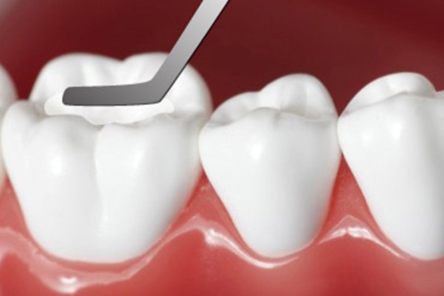 Tr&aacute;m răng c&oacute; l&acirc;u kh&ocirc;ng? Giải đ&aacute;p từ chuy&ecirc;n gia v&agrave; c&aacute;ch r&uacute;t ngắn thời gian hiệu quả 