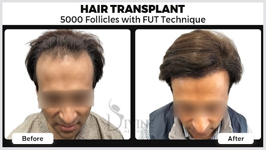Hair Transplant in Gurgaon: Your Ultimate Guide to Cost, Clinics, and Confidence