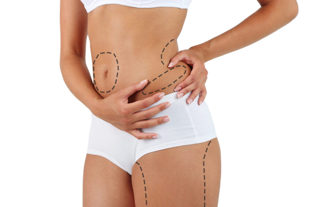 Liposuction Cost in Dubai Explained in Simple Terms