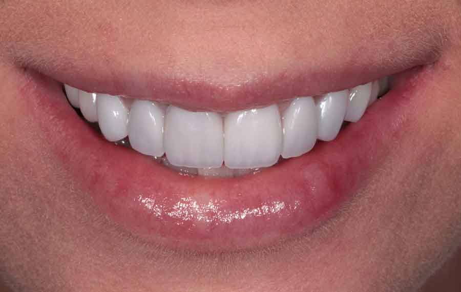 Dubai Teeth Whitening: What&rsquo;s the Real Price?