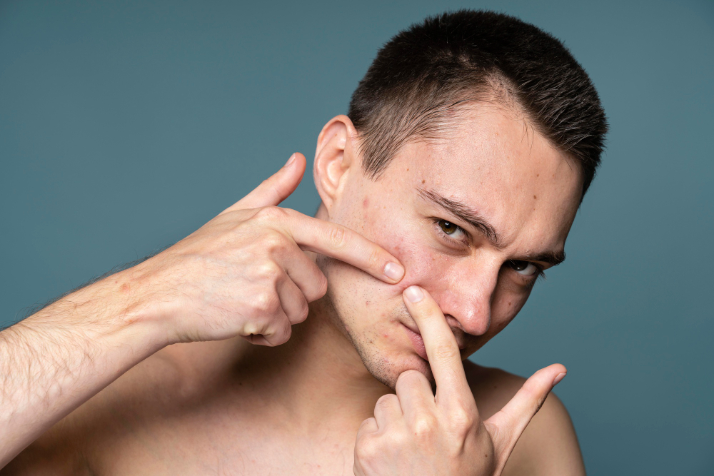 Real Ways to Get Rid of Pimples Overnight: Practical Steps That Work