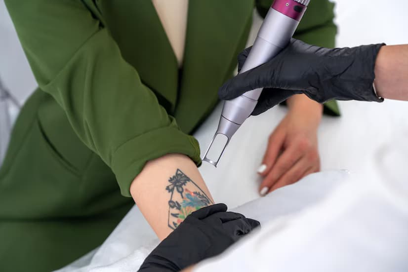 Effective Tattoo Removal in Birmingham: Methods, Costs, and Aftercare