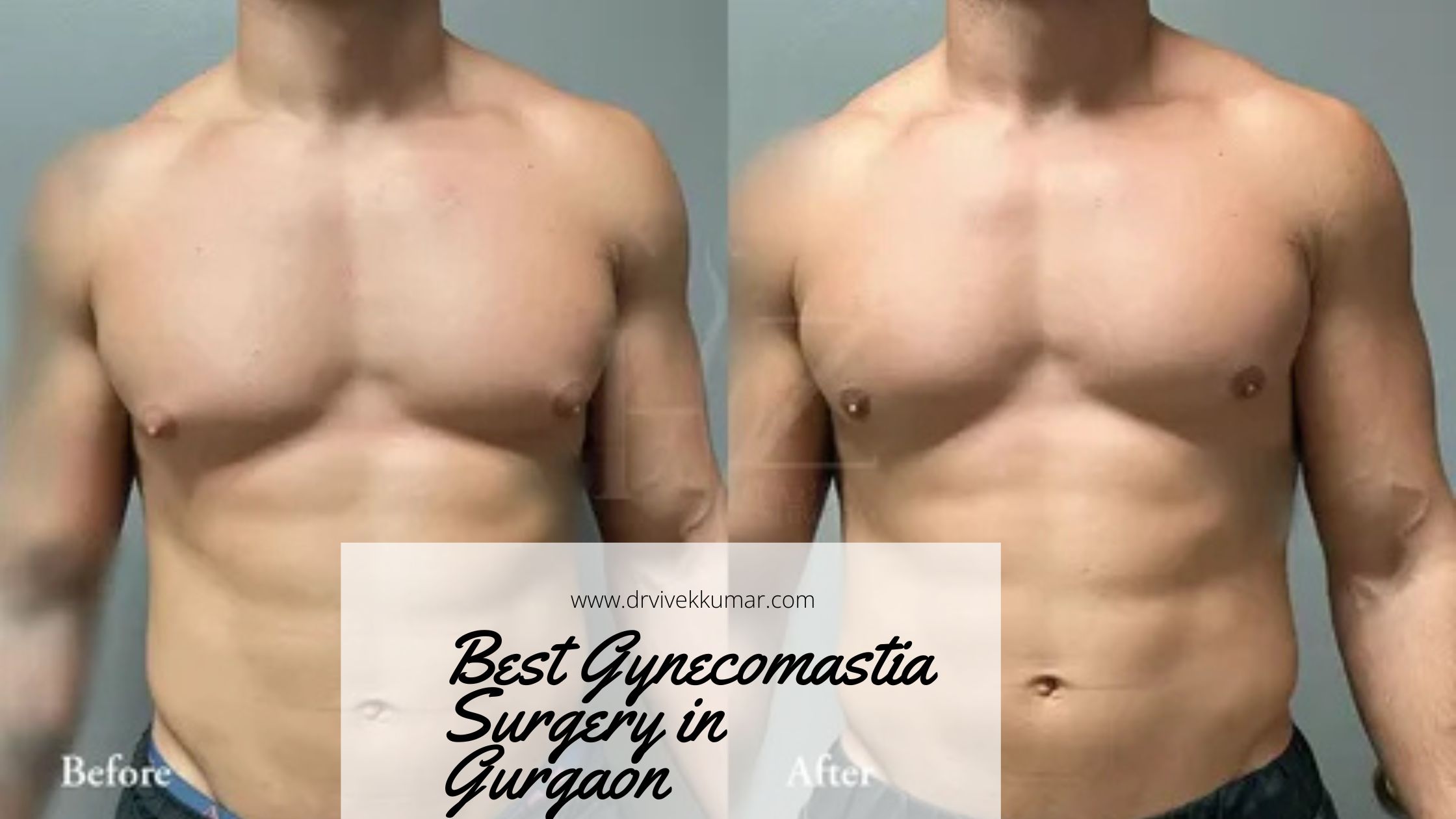 Best Gynecomastia Surgery in Gurgaon &ndash; Regain Your Confidence with Expert Care