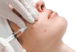 Acne Treatment in Ahmedabad: Effective Clinical Care & Clear-Skin Plan by Dr. Krupa