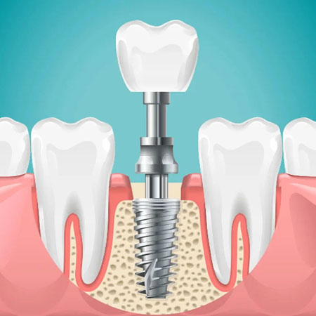 Best Dental Clinic in Kondapur, Hyderabad | Serene Smiles Dental Care