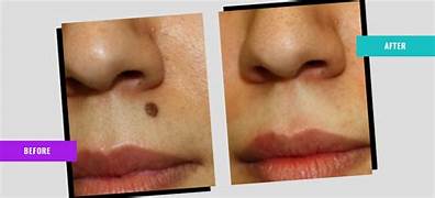 Birth Mark Removal Treatment In India - Expert Dermatology Care for Birthmark Reduction & Advanced Skin Laser Treatments