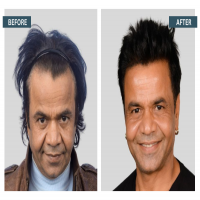 Hair transplant cost in India 